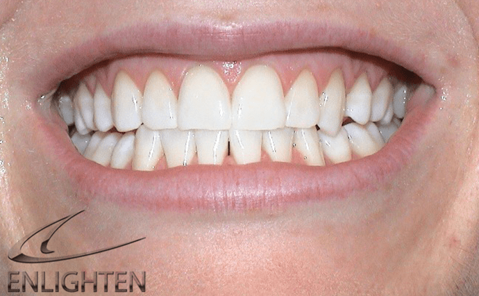 After - Wine Street Dental