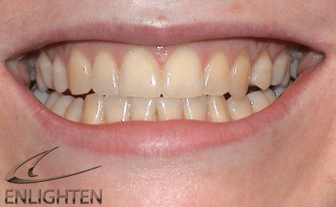 Before - Wine Street Dental