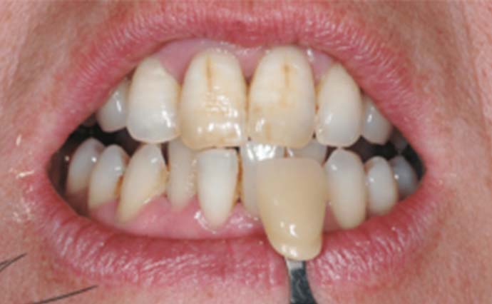 Before - Wine Street Dental