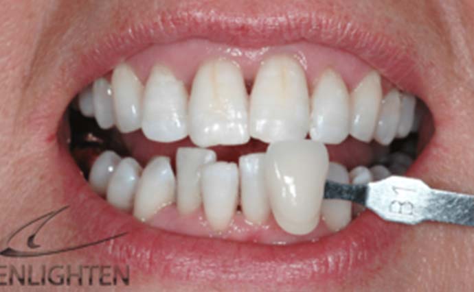 After - Wine Street Dental