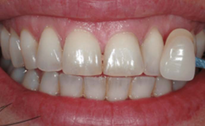 Before - Wine Street Dental