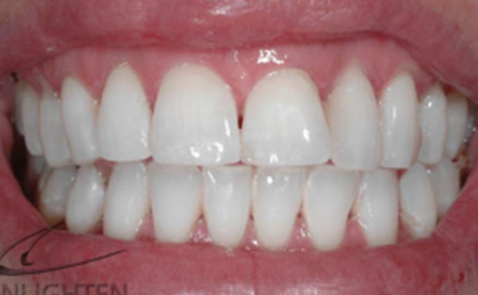 After - Wine Street Dental