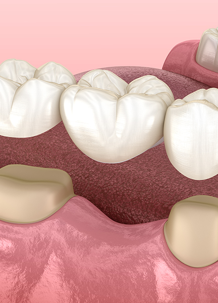 Treatment - Wine Street Dental