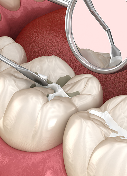 Treatment - Wine Street Dental