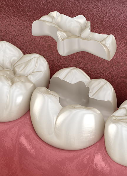 Treatment - Wine Street Dental