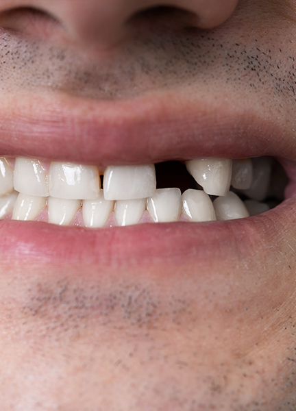 Treatment - Wine Street Dental