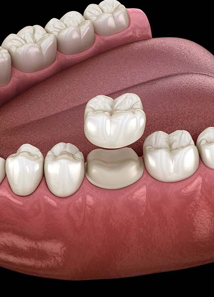 Treatment - Wine Street Dental