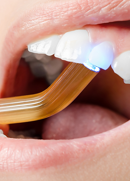 Treatment - Wine Street Dental