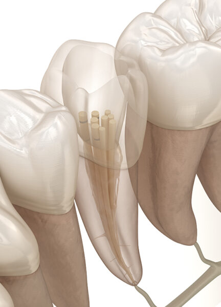 Treatment - Wine Street Dental