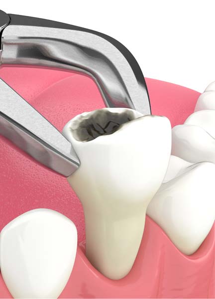 Treatment - Wine Street Dental