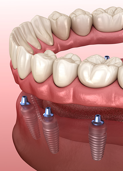 Treatment - Wine Street Dental
