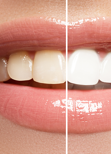 Treatment - Wine Street Dental