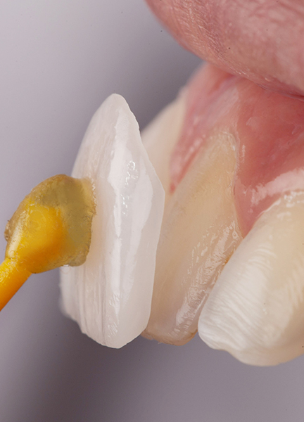 Treatment - Wine Street Dental