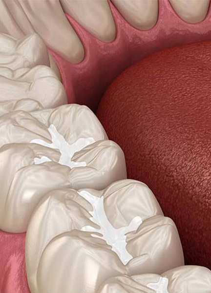 Treatment - Wine Street Dental